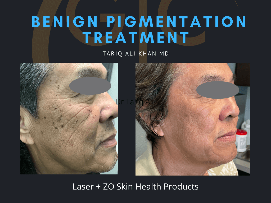 Gentle Care Laser Tustin & Long Beach Before and After picture - Mole Removal